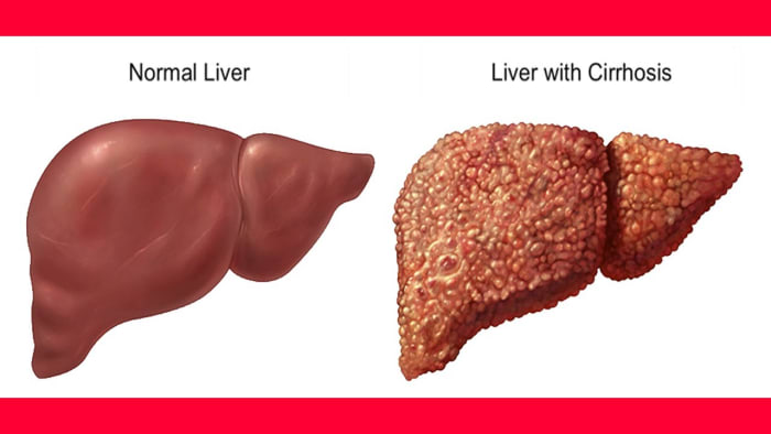 the-pathology-of-the-liver-hubpages