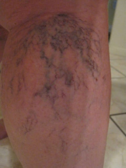 A before photo of my lower right leg before treatments. As you can see, the veins are pronounced and dark.