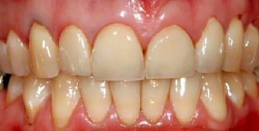 Swollen Gums - Symptoms, Causes, Treatment, Pictures - HubPages