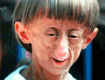 blog.medfriendly.com Progeria this child could be anywhere between 3 years old to approx 10 years old!