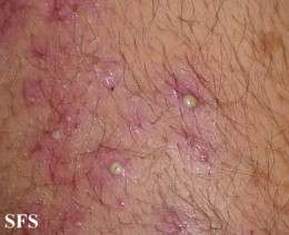 Staphylococcal folliculitis