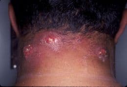 Carbuncles on the back of the neck
