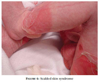 Staphylococcal scalded skin syndrome in an infant