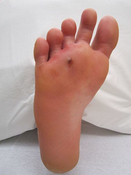 An infected puncture wound on the sole of the foot
