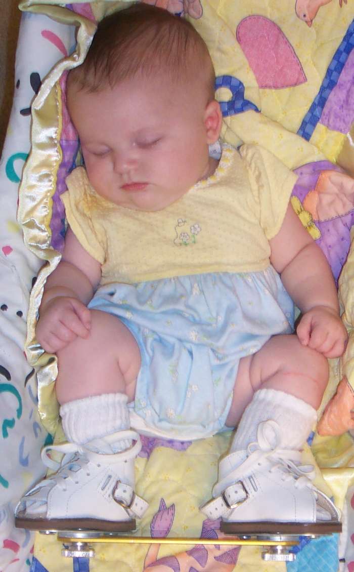 Conditions like clubbed feet raise the odds of shin splits later in life.