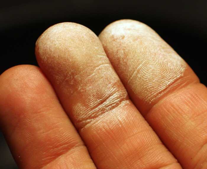 Fingers turn white when exposed to 30% Hydrogen Peroxide