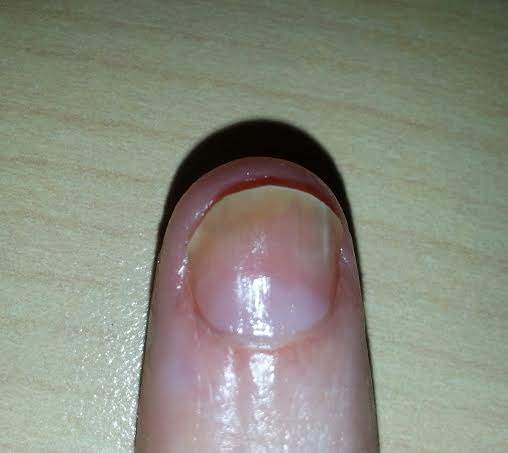 Nail Psoriasis with Fungus (My Right Pointer Finger Nail) Recently treated with steroid injections, and daily with my nail oil, and Vicks.
