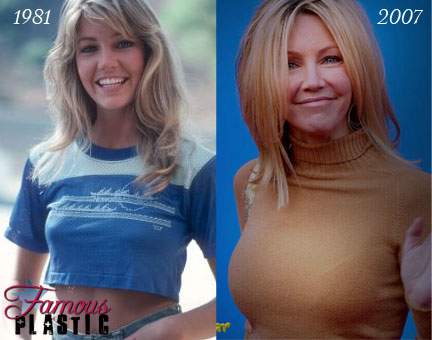 Heather had a nose job and breast implants, lip injections, botox, injectable fillers and possibly a facelift.