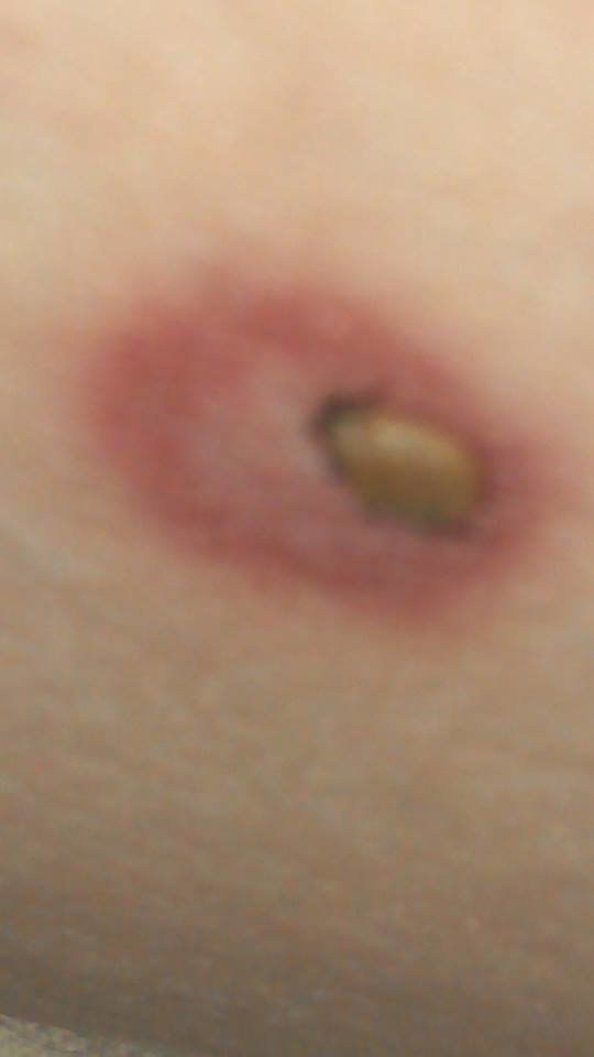 This Arkansas woman went to the doctor with this clear bulls eye and was told "...it's nothing, don't worry about it." You can see the tick is still embedded.