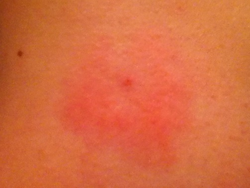 Rash from tick bite on individual in Little Rock. Source of photo informs author that rash originally had white clearing in the middle. The PCP positively identified as bulls eye; Individual clinically diagnosed with Lyme Disease