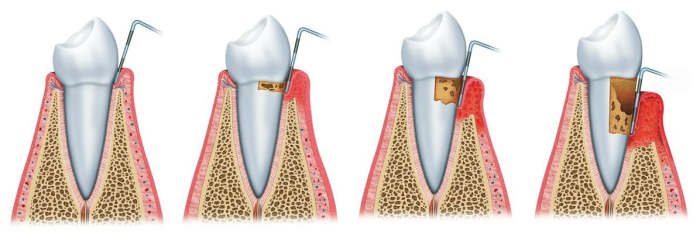 Gum disease progresses from minor irritation, to gingivitis, to periodontitis and advanced periodontitis, the point where you are at risk of losing the tooth. Protect yourself and your family with our guide!