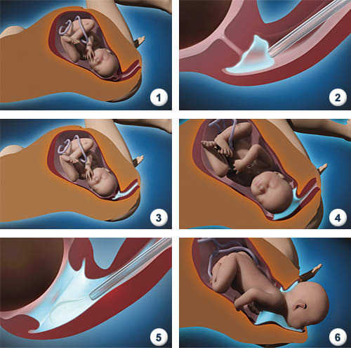 Indution of Labour - Diagramatical representation of How a Prostaglandin Gel is administered.