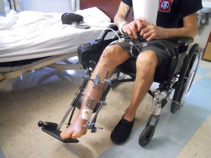 Leg Being Supported By An External Fixator. Photo shows tube coming from wound to a wound pump.