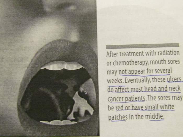 "After treatment with radiation or chemotherapy, mouth sores may not appear for several weeks. Eventually, these ulcers do affect most head and neck cancer patients. The sores may be red or have small white patches in the middle."
