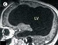 The image of a brain with massive damage whose owner has normal language function Credit: The Wikipedia