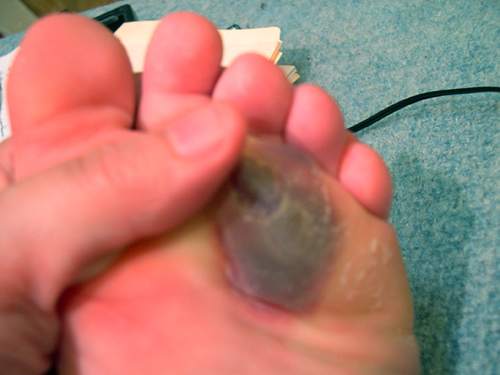 Honestly, this is one of the less gross pictures I found. My blister extended over a larger surface near the arch of my foot.