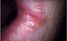 Angular cheilitis.