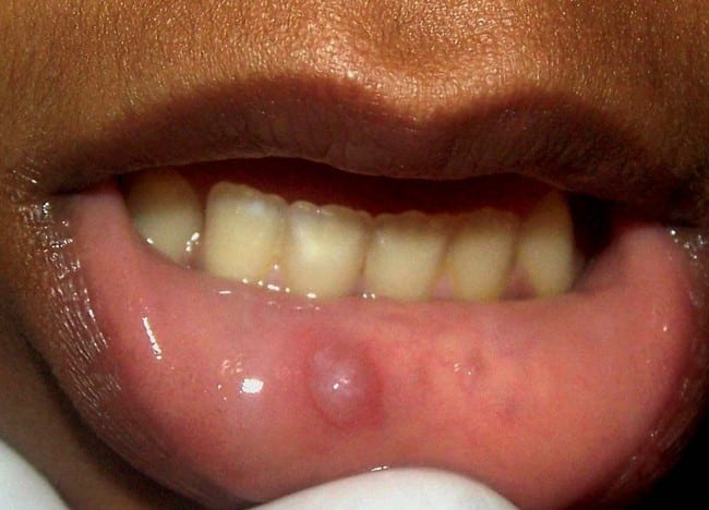 Pictures, Causes, Symptoms & Treatment of Oral Mucocele - HubPages