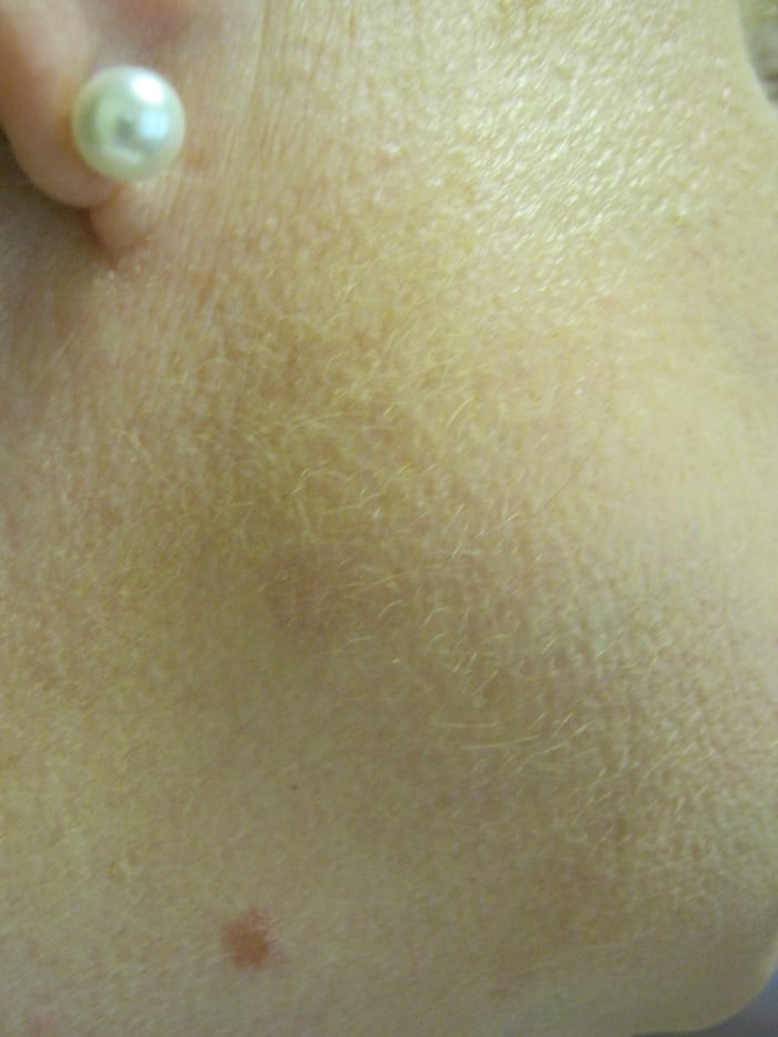 The place where two moles used to be, now this one is just a pink spot that keeps fading as weeks go by. It is about an inch above my other mole, that I still have. The one that disappeared used to be a fairly large, raised brown mole.