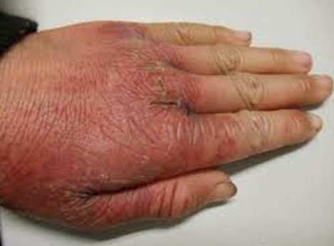 Pellagra - Pictures, Symptoms, Treatment, Causes, Diagnosis - HubPages