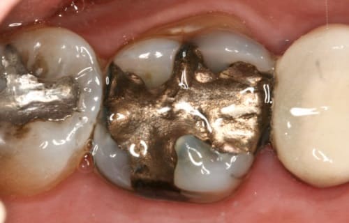 When two different types of metal come together in a solution, the metals effectively become a battery. In the mouth, this is called oral galvanism.