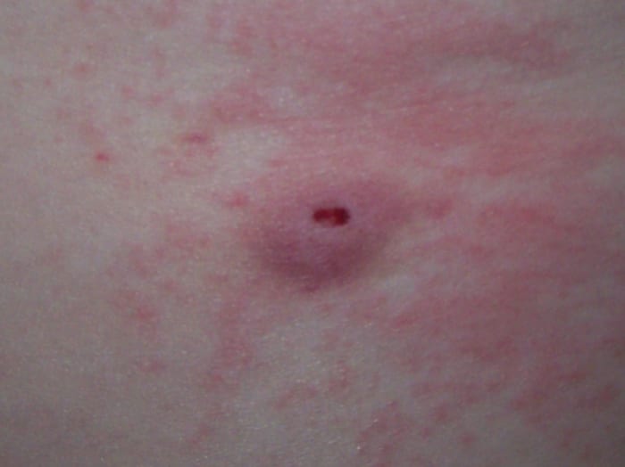 Here is the surgical site on the skin over my left kidney. The shockwaves left this welt and discoloration only for a couple of days.