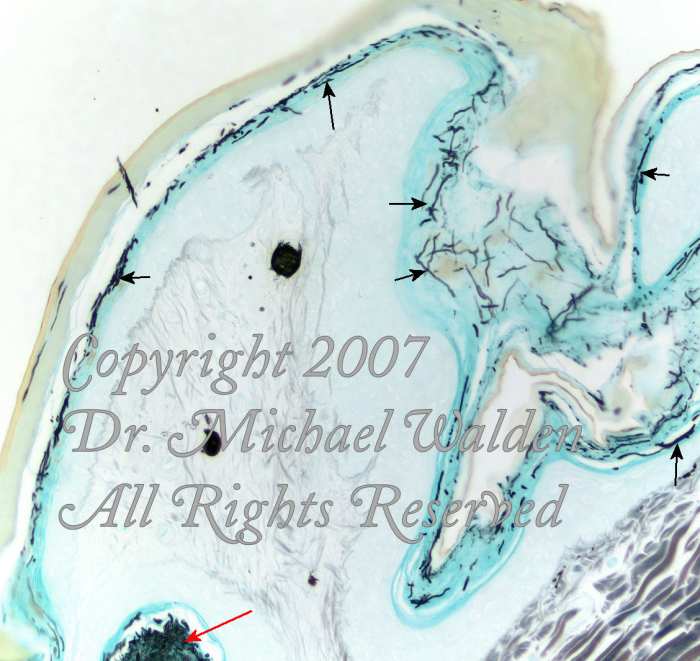 GMS with Hematoxylin counter stain of skin. Black filaments (arrows) are fungal hyphae. Note the invasion of the alpha keratin layers of the stratum corneum. Red arrow = mass of fungal hyphae in interscalar space.