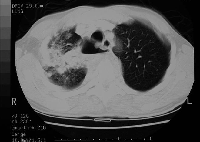 CT scan of a lung abscess inside (middle bottom: spine, midline top: heart, left, in black: left lung, left: complex solid/liquid/air lesion = abscess)