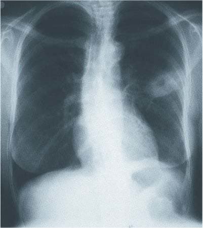 A 45-year-old white woman with no significant past medical history presented with a 2- to 3-week history of malaise, night sweats, and a cough that produced dark green, malodorous sputum. She reported no other symptoms. The patient's social history w