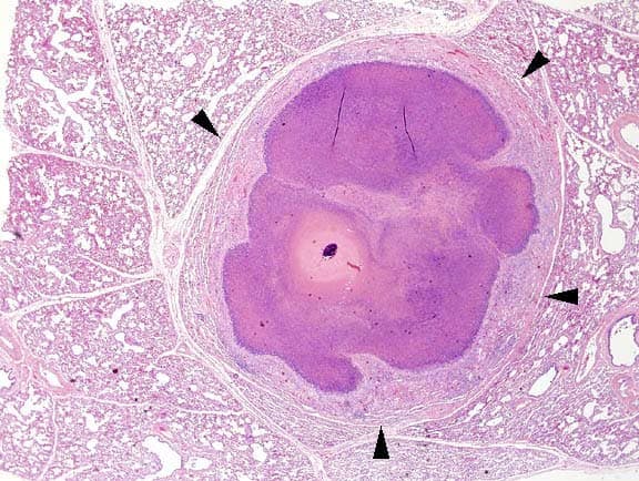 Low magnification view of an abscess in the lung. Note well-circumscribed fibrous connective 'capsule' (arrowheads) and central area of mineralization.