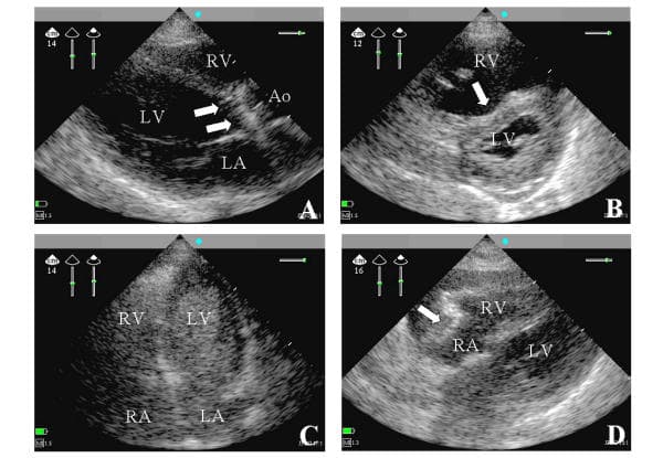 Examples of two-dimensional still frames obtained from hand-held echocardiographic examinations of four distinct patients.