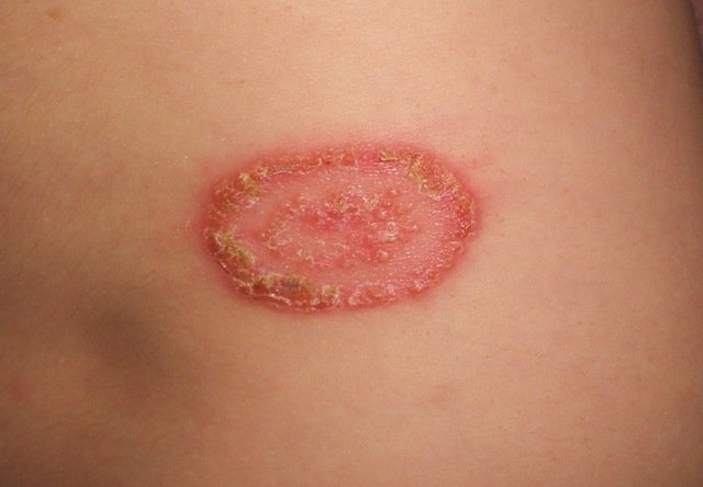 Topical Treatments For Ringworm - HubPages