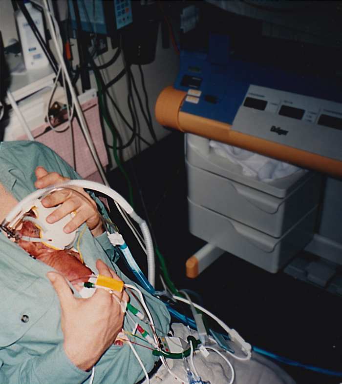 This photo shows my daughter, with IV drips, monitor wires and a CPAP tube to help her breathe, being held by my husband in Kangaroo Care.
