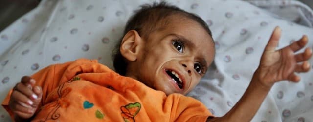 This may result from iodine deficiency occurring in endemic goiter belts. Babies born to hypothyroid women or those taking antithyroid drugs during pregnancy may develop cretinism.