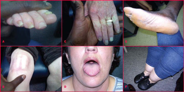 Clinical features of hypothyroidism depend on the age of onset of the disorder and the type.