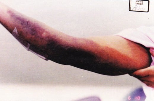 Prosecution claim Darlie inflicted these wounds on herself before or after she stabbed her sons and ran and threw a sock down the alley.
