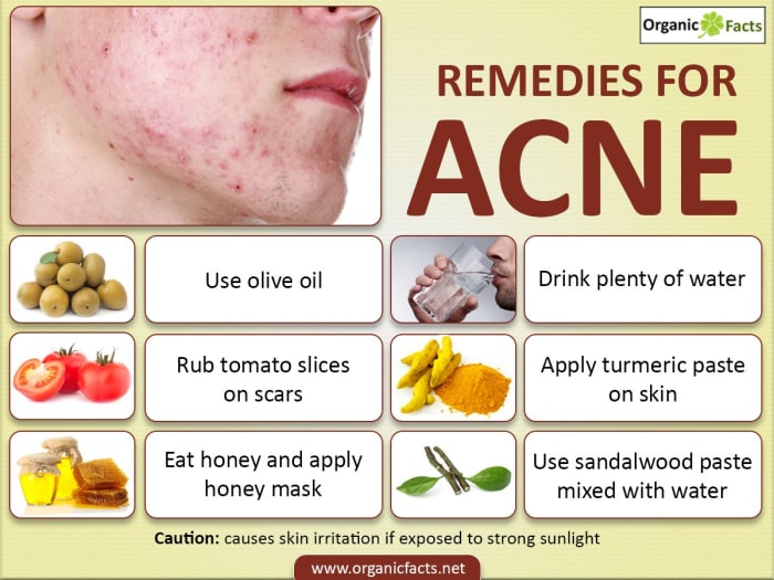 5 Home Remedies To Treat And Get Rid Of Pimples Hubpages