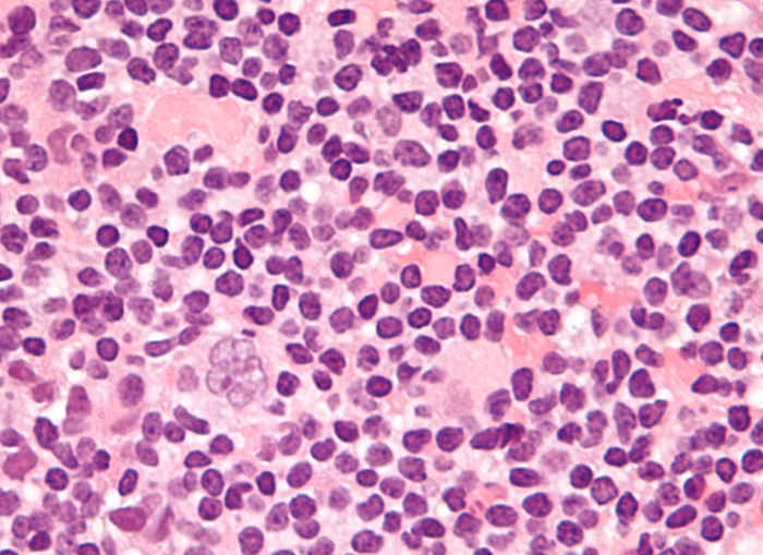 This is the type of Hodgkin's that I had when I was diagnosed the second time. Of the four types it is the most common with large tumor nodules. One of them is clearly visible slightly off center toward the bottom left.