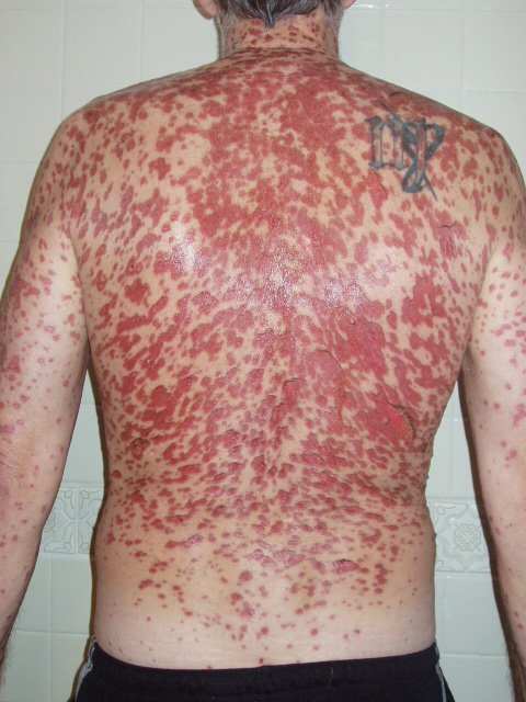Constant pain for months on end. Recovery, five years later still is ongoing! (declaration: pictures, story and name are copyright ownership by the author Dan W. Miller The Vanilla Godzilla. You do not have my permission to use.)