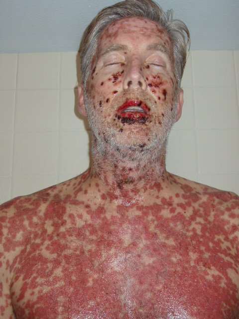 SJS can cause open sores from popped welts coming from the inside to the surface. Many patients end up in a burn unit. Children are put in a drug induced coma because of the pain. My sister said I looked like a corpse. (copyright laws apply)