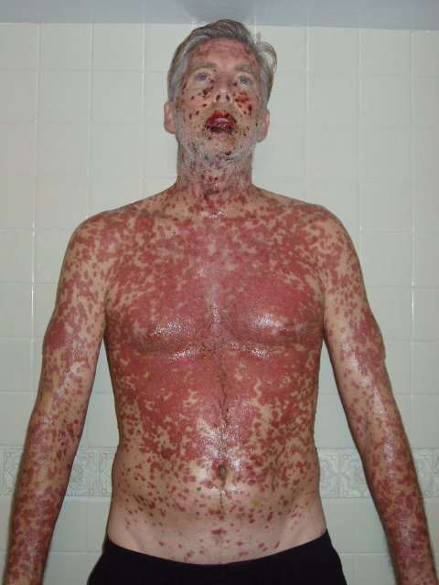 EVERYTHING hurt. Those are painful chemical burns from the inside out. 2 weeks into SJS/TENS , note: (declaration: pictures, story and name are copyright ownership by the author Dan W. Miller aka The Vanilla Godzilla.)