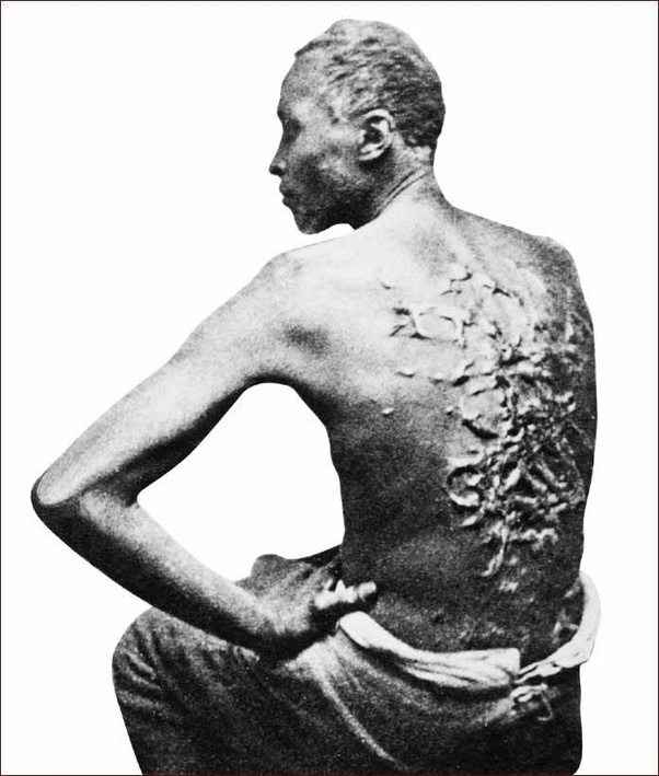 Lashing scars cover the back of this slave; punishments and their severity varied, but lashing was common for perceived insubordination