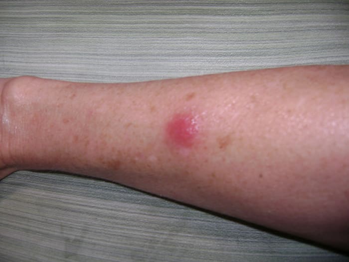 This bump started as a small mosquito bite looking thing. I noticed it the first week of June, approximately 4 weeks after exposure. NOT where the tick bit me. It is red, hard, puffy with slight fever in it.