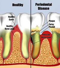 The picture on the left shows healthy teeth and gums,check for the symptoms of gum disease and visit your dentist if you spot any problems.