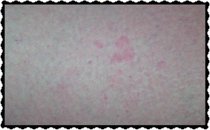 It looks like one, or maybe two. There are actually 3 separate bed bug bites in this picture. They are overlapping, which makes it hard to tell.