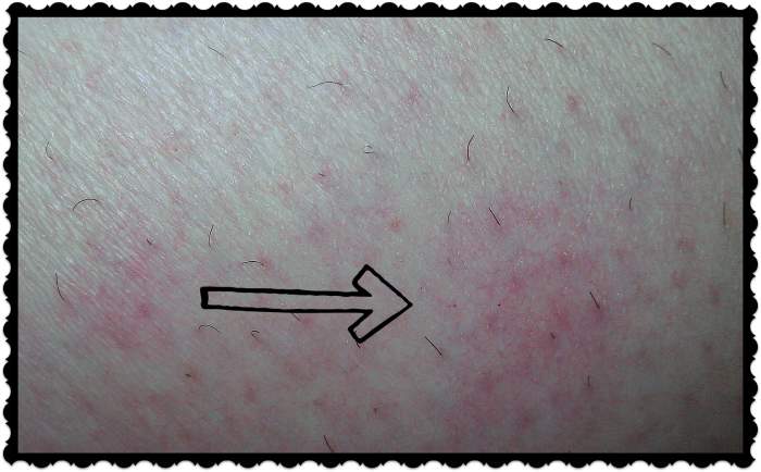 Here is a person who does not have the typical circular rash. Instead, this person reacts to bed bug bites with splotches.