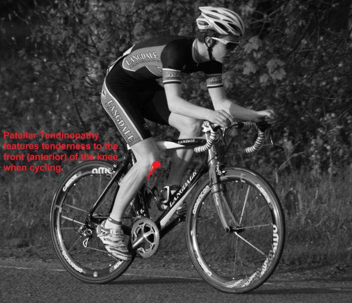 Patellar Tendinopathy pain manifests at the front of the knee in a more localized area than patellofemoral pain syndrome.