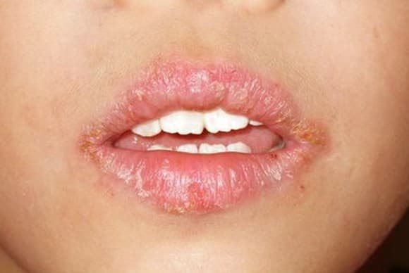 Angular Cheilitis - Pictures, Treatment, Symptoms, Causes - HubPages