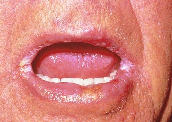 angular-cheilitis-pictures-treatment-symptoms-causes-hubpages