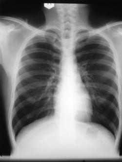 Inspiratory muscular actions are descent of the diaphragm (innervated by the phrenic nerve C3, C5) and contraction of the intercostal muscles of respiration are also recruited (sternomastoids and scalenes) during exercise or respiratory distress.